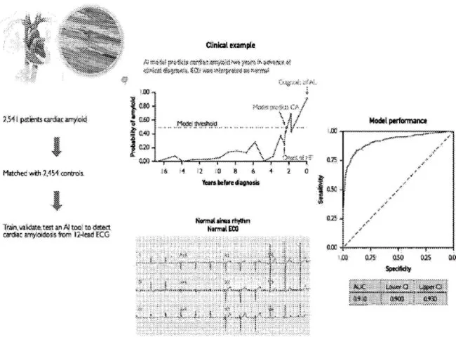 cardiac amyloid
